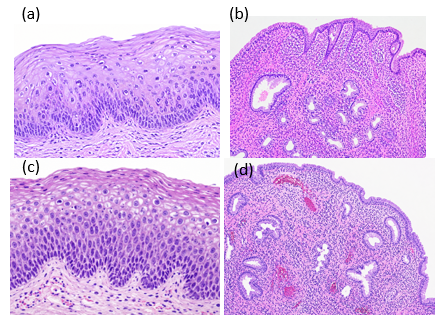 Representative histopathological findings of cervical lesions identified in the study. (a) CIN I; (b) chronic cervicitis; (c) CIN II; and (d) endocervical polyp. H&E staining